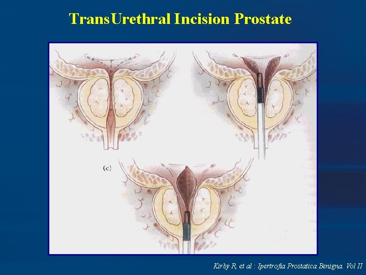 Trans. Urethral Incision Prostate Kirby R, et al : Ipertrofia Prostatica Benigna. Vol II