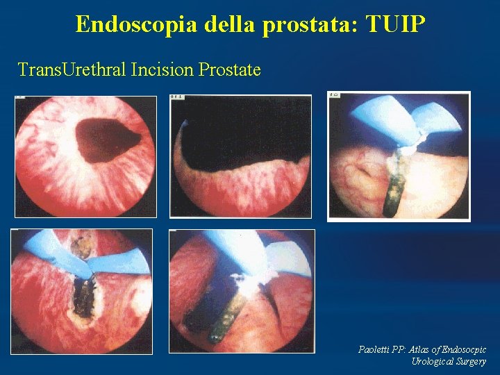 Endoscopia della prostata: TUIP Trans. Urethral Incision Prostate Paoletti PP: Atlas of Endosocpic Urological