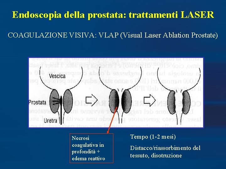 Endoscopia della prostata: trattamenti LASER COAGULAZIONE VISIVA: VLAP (Visual Laser Ablation Prostate) Necrosi coagulativa
