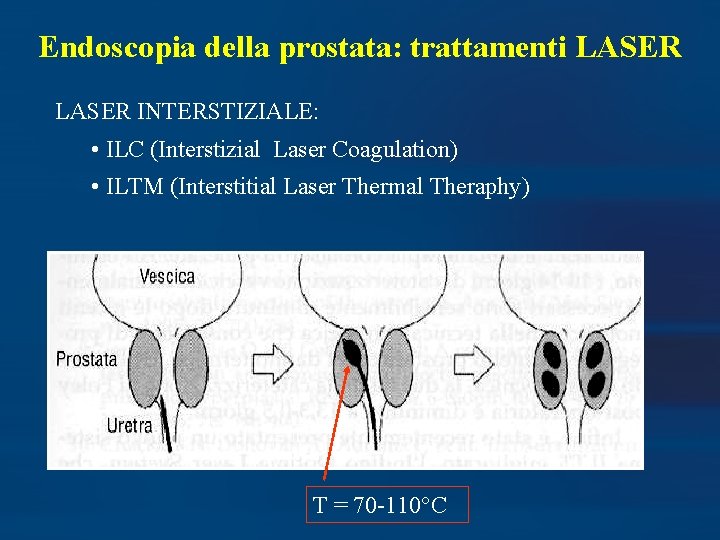 Endoscopia della prostata: trattamenti LASER INTERSTIZIALE: • ILC (Interstizial Laser Coagulation) • ILTM (Interstitial