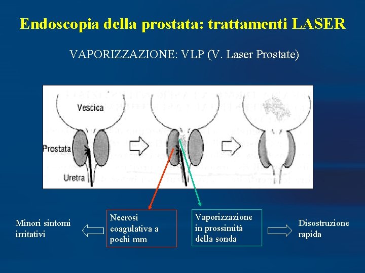 Endoscopia della prostata: trattamenti LASER VAPORIZZAZIONE: VLP (V. Laser Prostate) Minori sintomi irritativi Necrosi