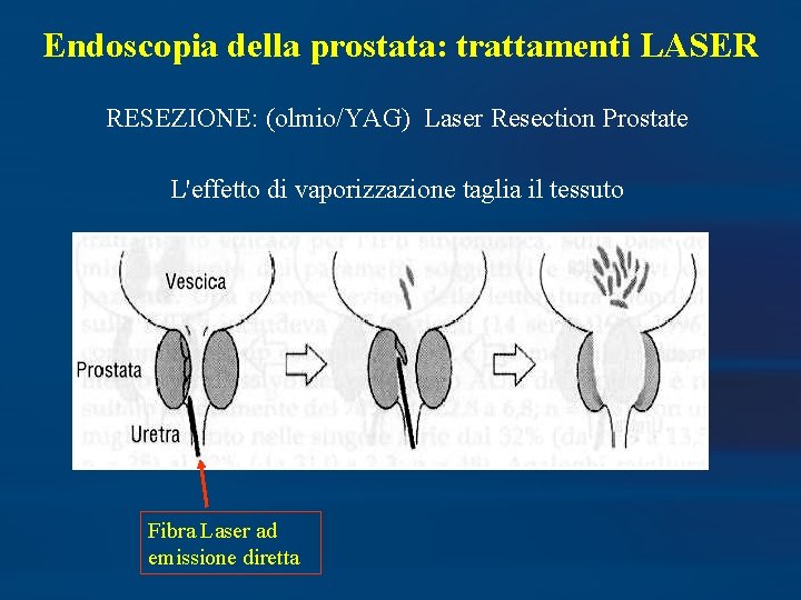Endoscopia della prostata: trattamenti LASER RESEZIONE: (olmio/YAG) Laser Resection Prostate L'effetto di vaporizzazione taglia