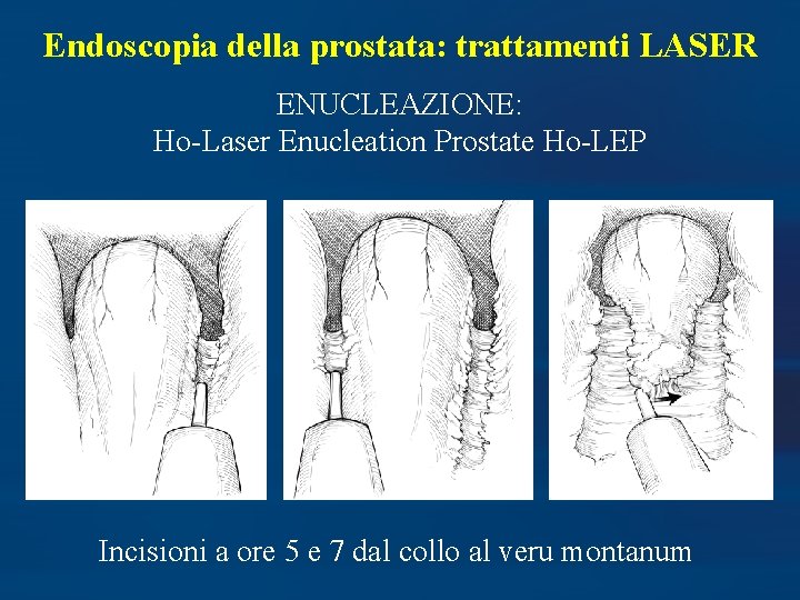 Endoscopia della prostata: trattamenti LASER ENUCLEAZIONE: Ho-Laser Enucleation Prostate Ho-LEP Incisioni a ore 5