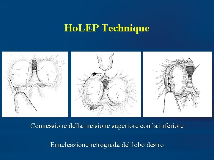 Ho. LEP Technique Connessione della incisione superiore con la inferiore Enucleazione retrograda del lobo
