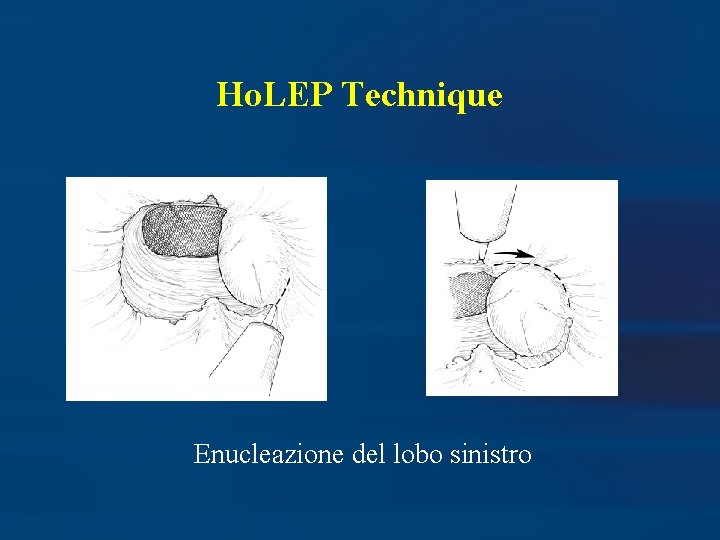 Ho. LEP Technique Enucleazione del lobo sinistro 
