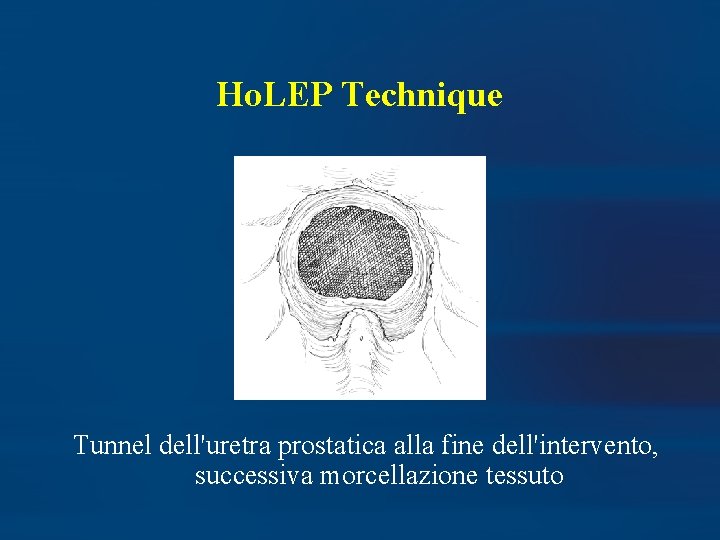 Ho. LEP Technique Tunnel dell'uretra prostatica alla fine dell'intervento, successiva morcellazione tessuto 