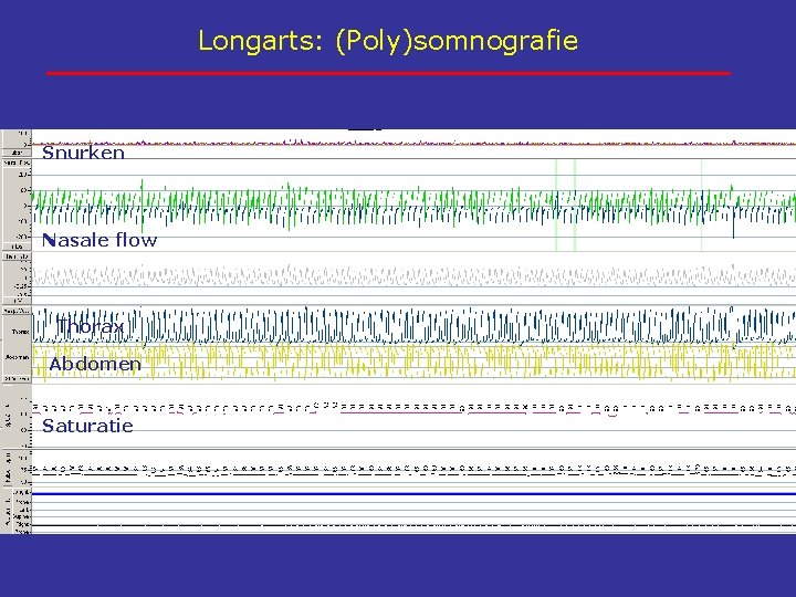 Longarts: (Poly)somnografie Snurken Nasale flow Thorax Abdomen Saturatie 