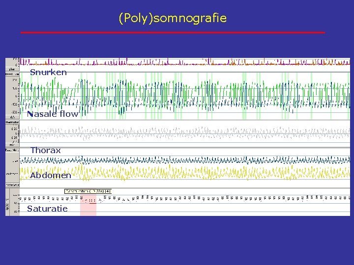 (Poly)somnografie Snurken Nasale flow Thorax Abdomen Saturatie 