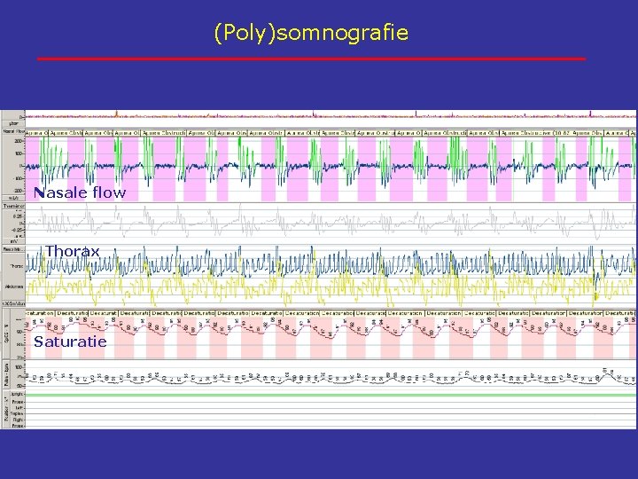 (Poly)somnografie Nasale flow Thorax Saturatie 