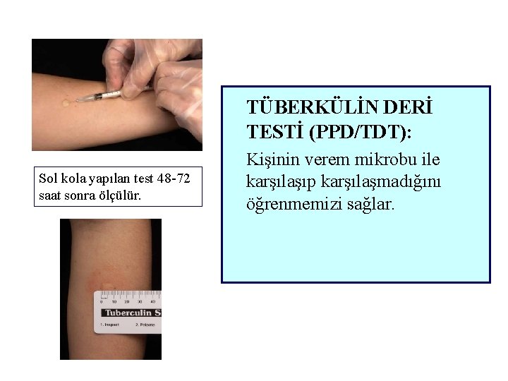 TÜBERKÜLİN DERİ TESTİ (PPD/TDT): Sol kola yapılan test 48 -72 saat sonra ölçülür. Kişinin