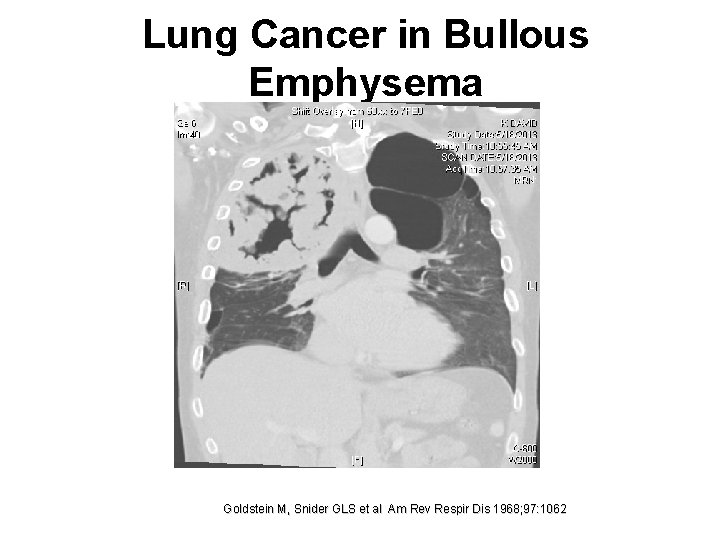 Lung Cancer in Bullous Emphysema Goldstein M, Snider GLS et al Am Rev Respir