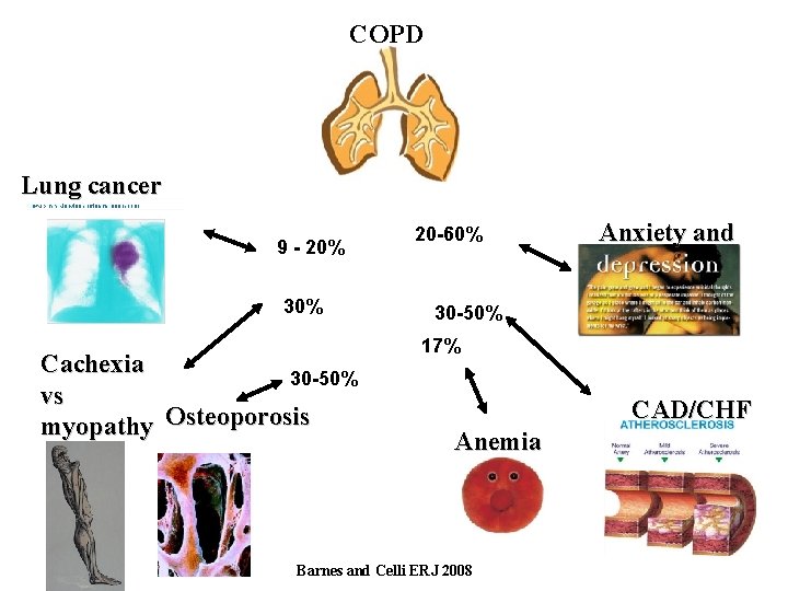 COPD Lung cancer 9 - 20% 30% Cachexia 30 -50% vs myopathy Osteoporosis 20