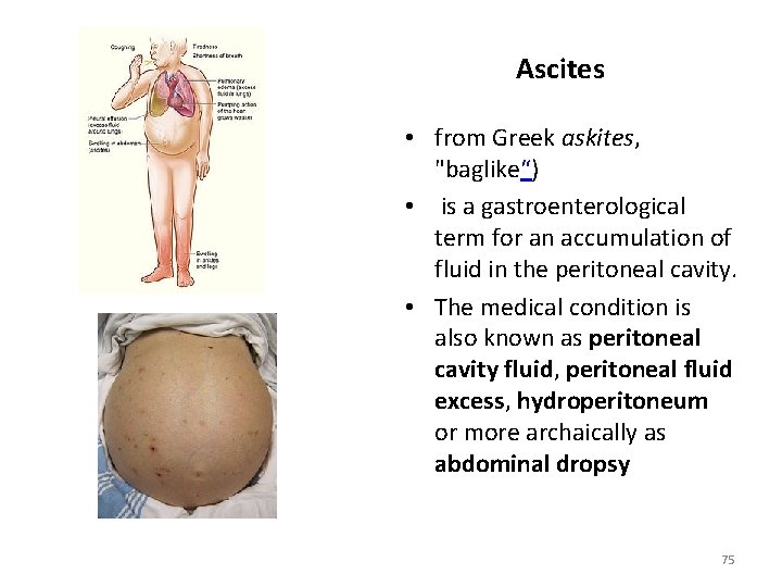 Ascites • from Greek askites, "baglike“) • is a gastroenterological term for an accumulation