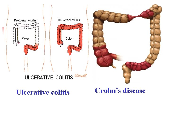 Ulcerative colitis Crohn's disease 