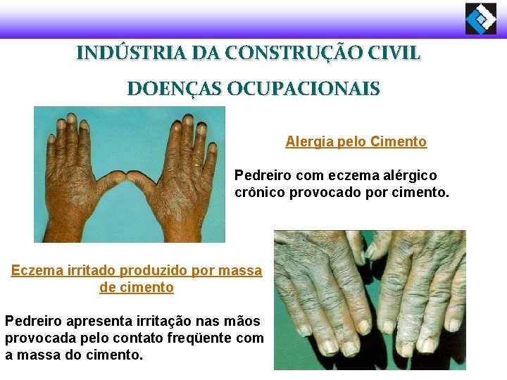 INDÚSTRIA DA CONSTRUÇÃO CIVIL DOENÇAS OCUPACIONAIS Alergia pelo Cimento Pedreiro com eczema alérgico crônico