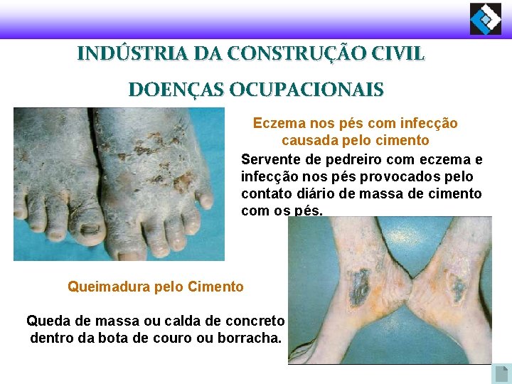 INDÚSTRIA DA CONSTRUÇÃO CIVIL DOENÇAS OCUPACIONAIS Eczema nos pés com infecção causada pelo cimento