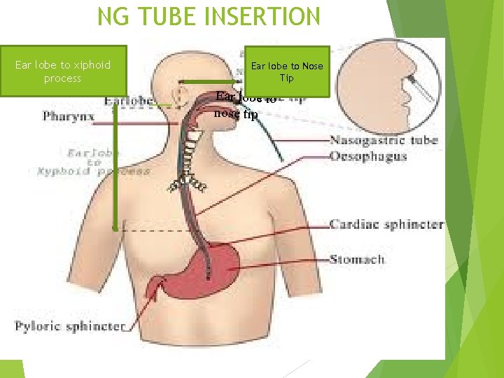 NG TUBE INSERTION Ear lobe to xiphoid process Ear lobe to Nose Tip Ear