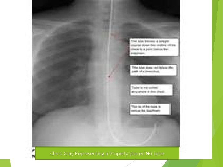 Chest Xray Representing a Properly placed NG tube 14 