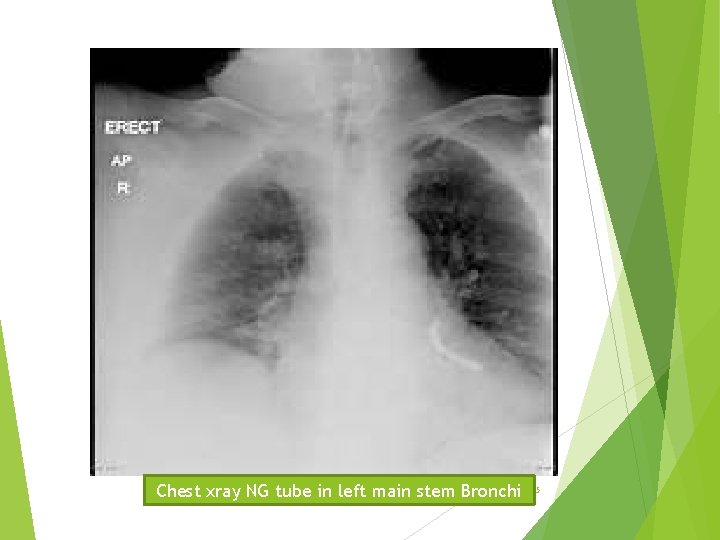 Chest xray NG tube in left main stem Bronchi 15 Chest xray NG tube in left main stem Bronchi 15