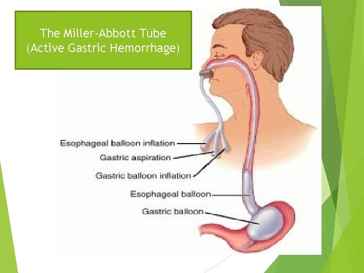 The Miller-Abbott Tube (Active Gastric Hemorrhage) 29 