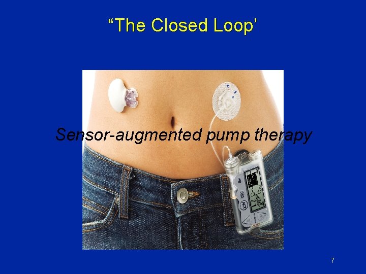 “The Closed Loop’ Sensor-augmented pump therapy 7 