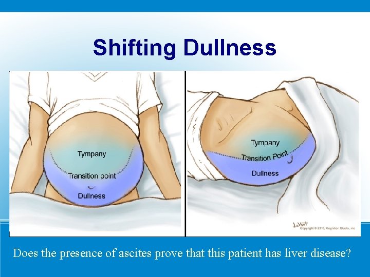 Shifting Dullness Does the presence of ascites prove that this patient has liver disease?