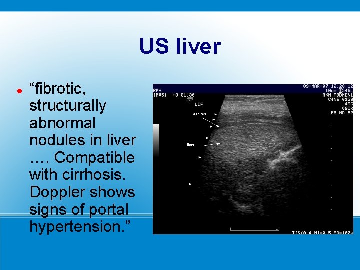 US liver “fibrotic, structurally abnormal nodules in liver …. Compatible with cirrhosis. Doppler shows