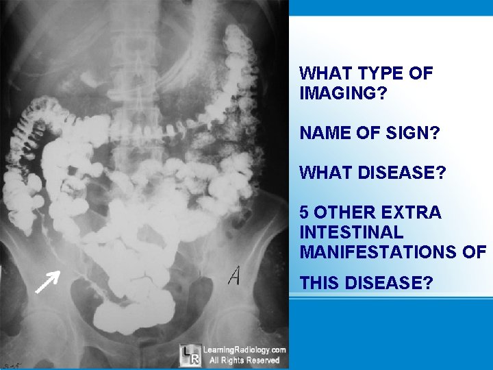 WHAT TYPE OF IMAGING? NAME OF SIGN? WHAT DISEASE? 5 OTHER EXTRA INTESTINAL MANIFESTATIONS