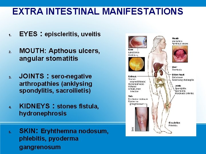 EXTRA INTESTINAL MANIFESTATIONS 1. 2. 3. EYES : episcleritis, uveitis MOUTH: Apthous ulcers, angular