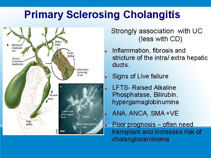 Primary Sclerosing Cholangitis Strongly association with UC (less with CD) Inflammation, fibrosis and stricture