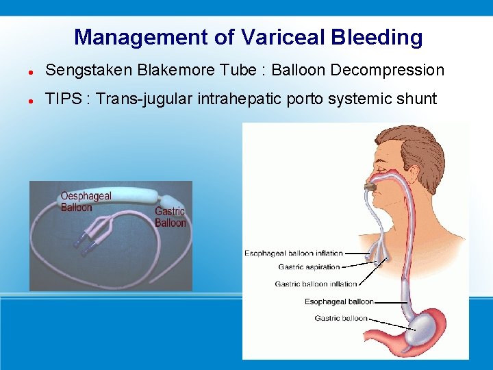 Management of Variceal Bleeding Sengstaken Blakemore Tube : Balloon Decompression TIPS : Trans-jugular intrahepatic