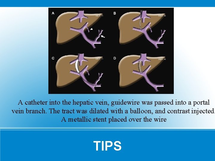 A catheter into the hepatic vein, guidewire was passed into a portal vein branch.