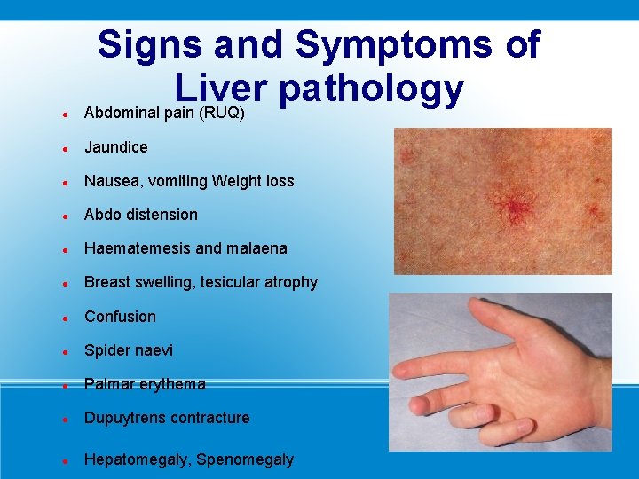  Signs and Symptoms of Liver pathology Abdominal pain (RUQ) Jaundice Nausea, vomiting Weight