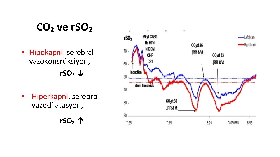 CO₂ ve r. SO₂ • Hipokapni, serebral vazokonsrüksiyon, r. SO₂ ↓ • Hiperkapni, serebral