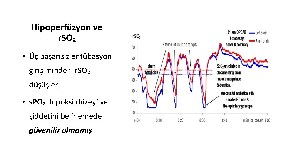 Hipoperfüzyon ve r. SO₂ • Üç başarısız entübasyon girişimindeki r. SO₂ düşüşleri • s.