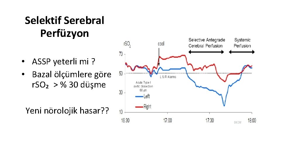 Selektif Serebral Perfüzyon • ASSP yeterli mi ? • Bazal ölçümlere göre r. SO₂