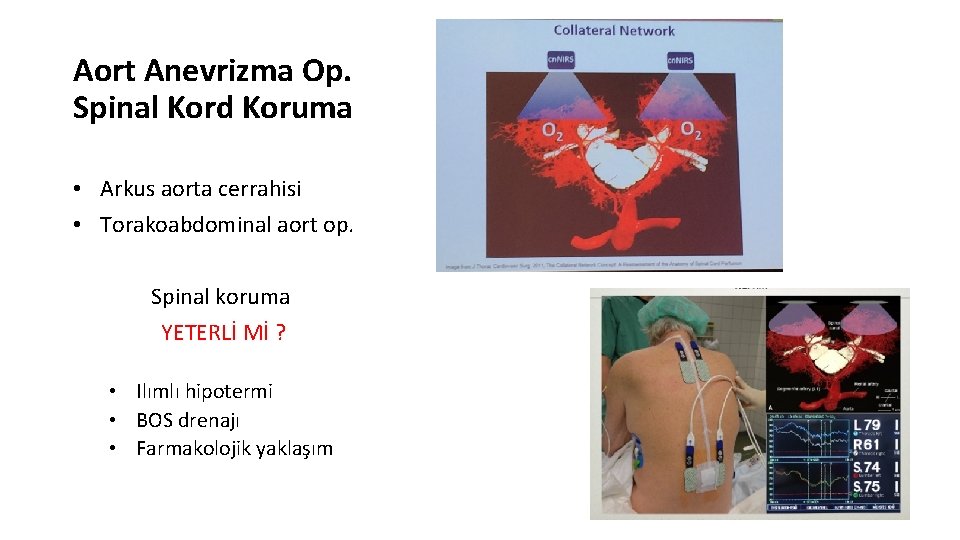 Aort Anevrizma Op. Spinal Kord Koruma • Arkus aorta cerrahisi • Torakoabdominal aort op.