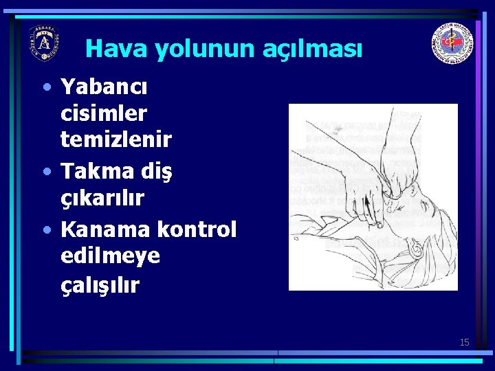 Hava yolunun açılması • Yabancı cisimler temizlenir • Takma diş çıkarılır • Kanama kontrol