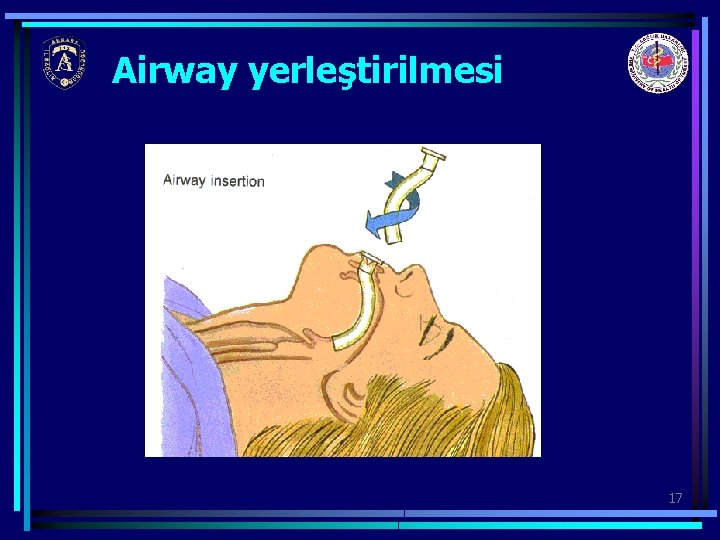 Airway yerleştirilmesi 17 