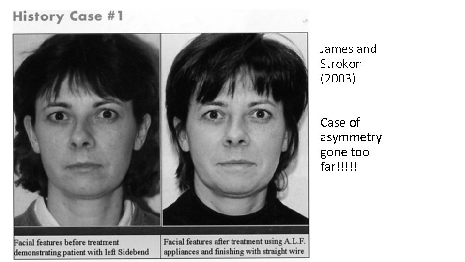 James and Strokon (2003) Case of asymmetry gone too far!!!!! 