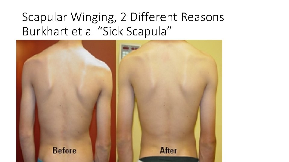 Scapular Winging, 2 Different Reasons Burkhart et al “Sick Scapula” 