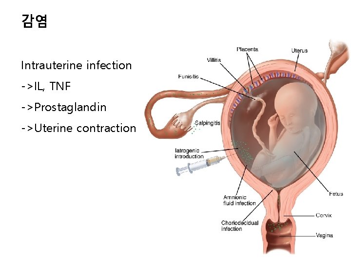 감염 Intrauterine infection ->IL, TNF ->Prostaglandin ->Uterine contraction 