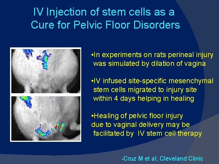 IV Injection of stem cells as a Cure for Pelvic Floor Disorders • In