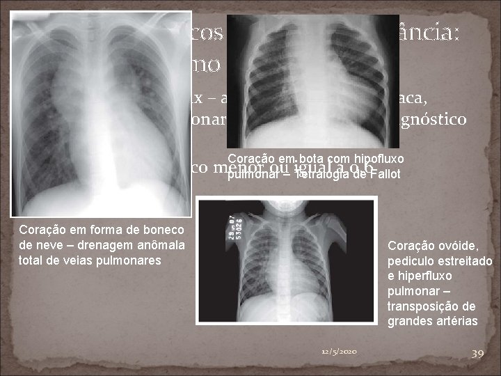 Sopros cardíacos suspeitos na infância: como investigar? ♥ Radiografia de tórax – avaliação da