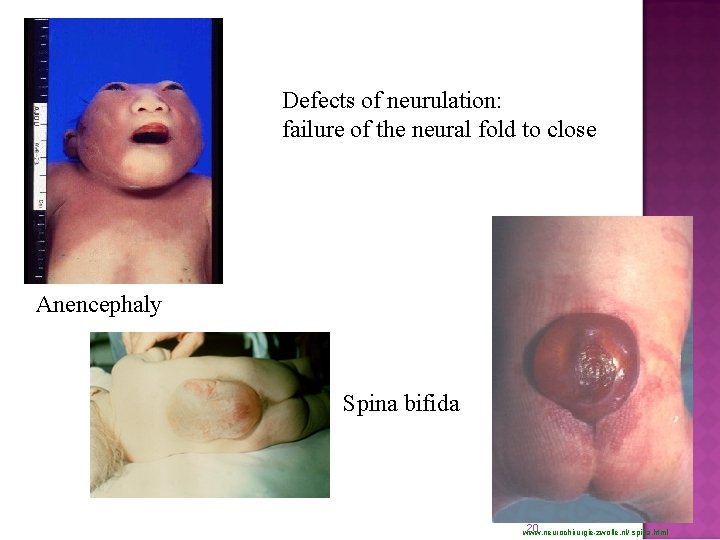 Defects of neurulation: failure of the neural fold to close Anencephaly Spina bifida 20