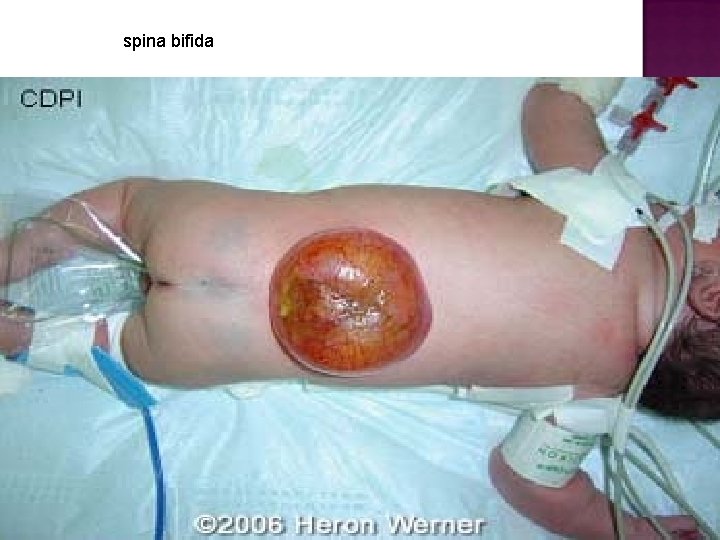 spina bifida 