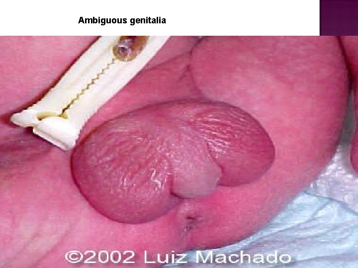 Ambiguous genitalia 