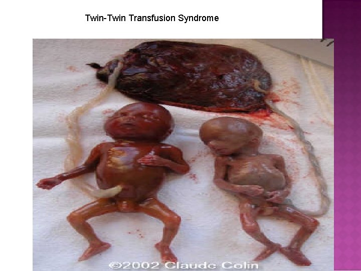 Twin-Twin Transfusion Syndrome 