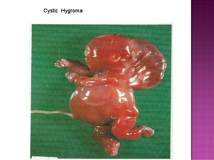 Cystic Hygroma 