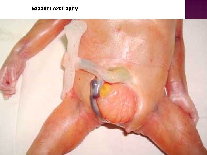 Bladder exstrophy 